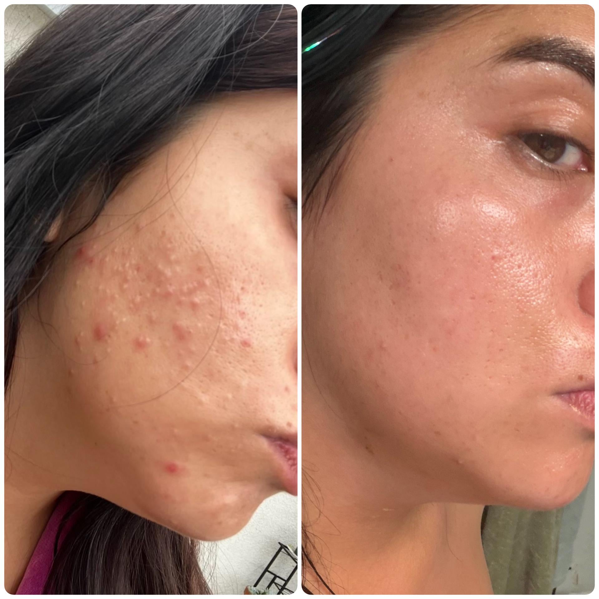 Medicube Zero Pore Pad 2.0